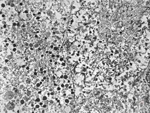 F,68y. | APUD carcinoma F,68y. | APUD carcinoma
